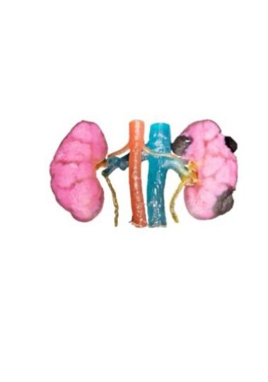 Picture of Kidney Cancer