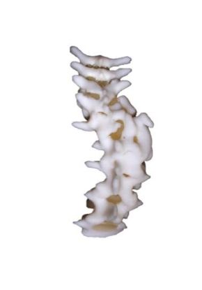 Picture of Spine Scoliosis