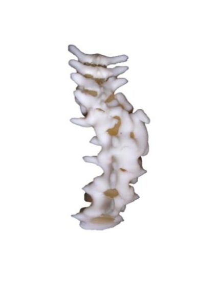 Picture of Spine Scoliosis